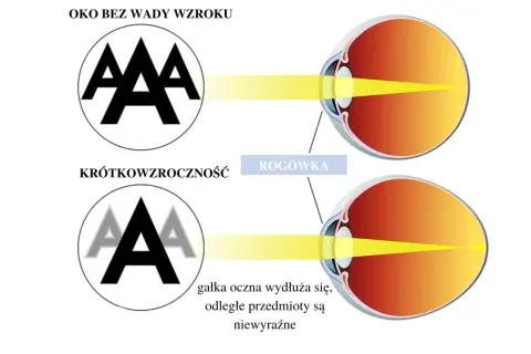 Oko zdrowe skupia światło na siatkówce, dając ostry obraz. W krótkowzroczności załamanie światła jest nieprawidłowe, obraz jest nieostry.