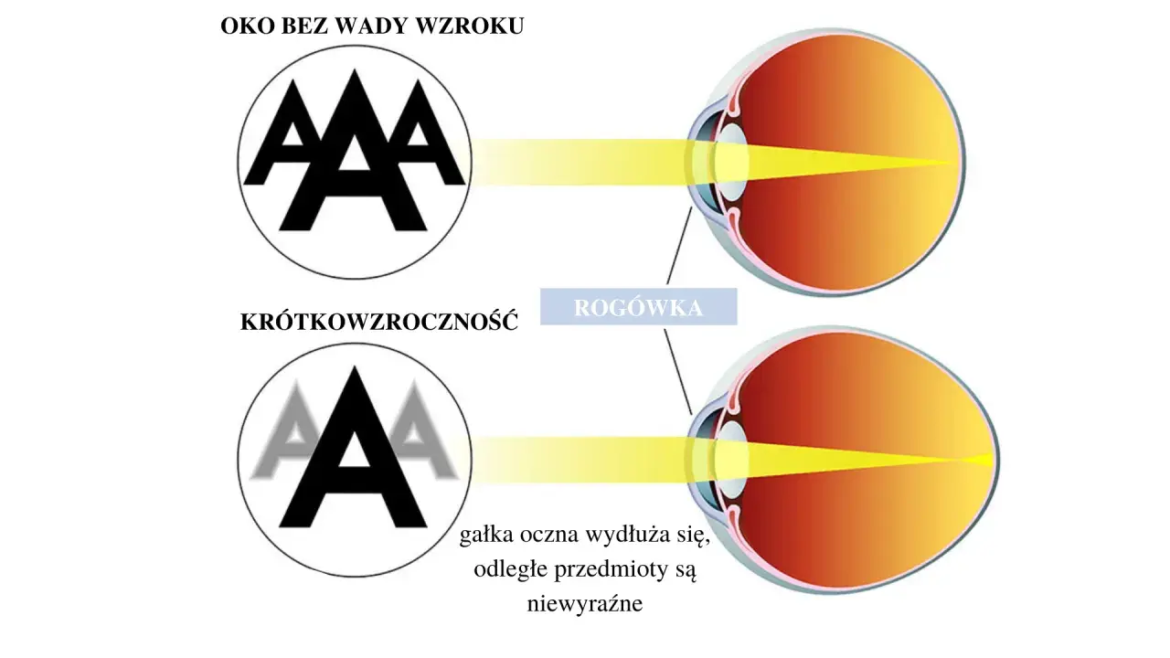Oko zdrowe skupia światło na siatkówce, dając ostry obraz. W krótkowzroczności załamanie światła jest nieprawidłowe, obraz jest nieostry.