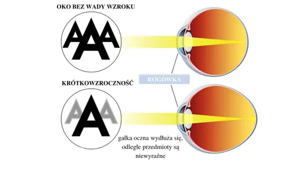 Oko zdrowe skupia światło na siatkówce, dając ostry obraz. W krótkowzroczności załamanie światła jest nieprawidłowe, obraz jest nieostry.